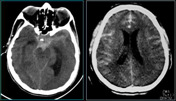 Xuất huyết dưới màng nhện - Hình ảnh minh họa